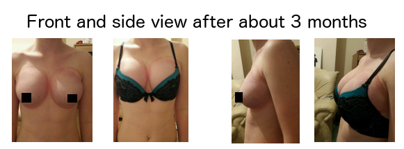 Nooglebery breast enlargement before and after results